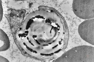 M,43y. | fungi in blood (Candida v.s.) - mycoseption M,43y. | fungi in blood (Candida v.s.) - mycoseption